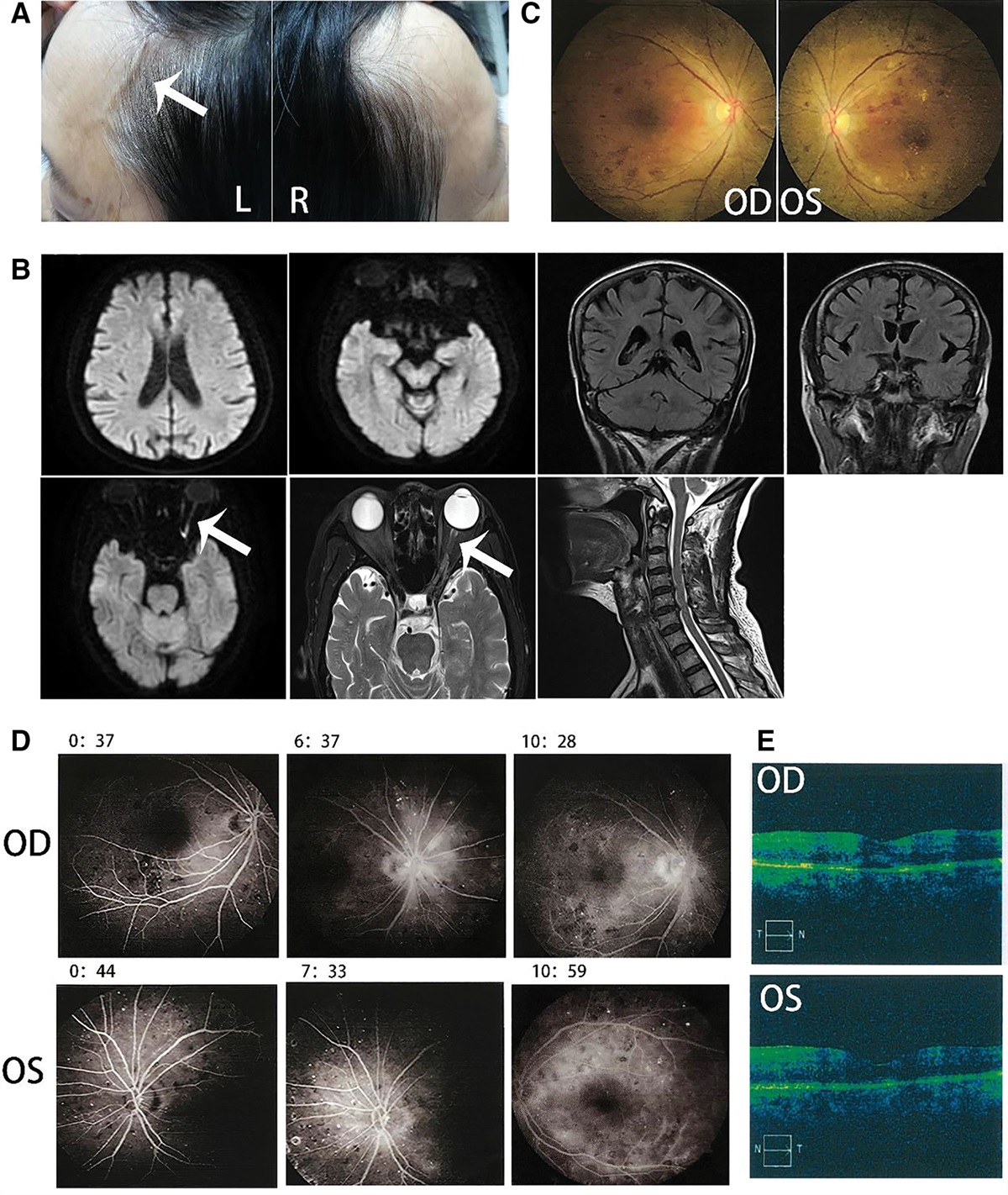 Case report: GCA like picture-preceding inaugural MOGAD presentation: A patient with a sudden-onset uniocular blindness