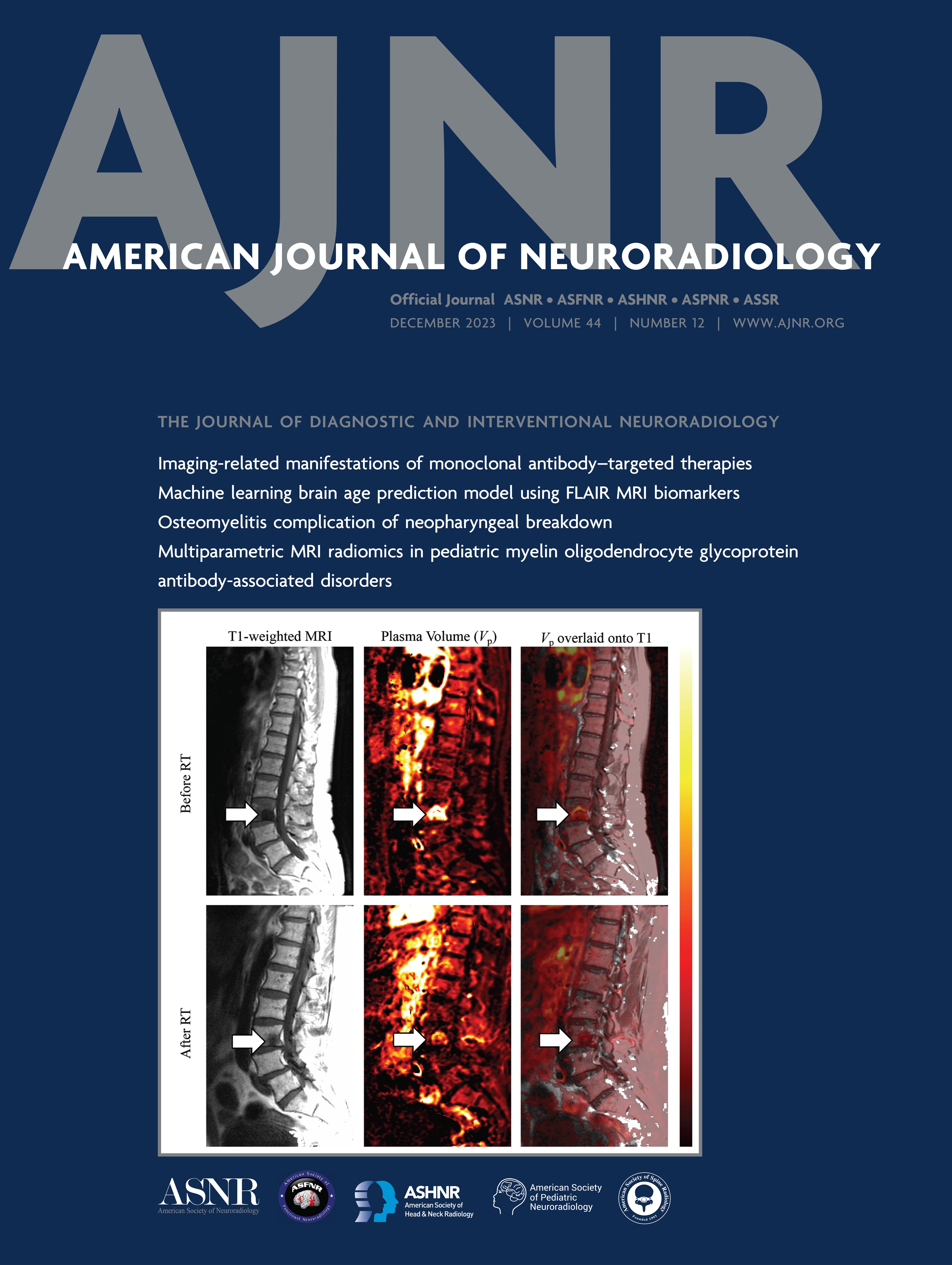 CT of the Larynx: Is an Additional High-Resolution Acquisition Necessary for Diagnostic Accuracy? [HEAD AND NECK IMAGING]