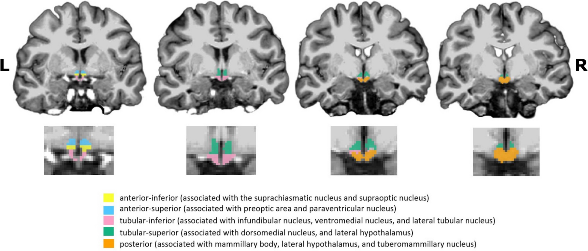 Involvement of the ipsilateral-to-the-pain anterior–superior hypothalamic subunit in chronic cluster headache