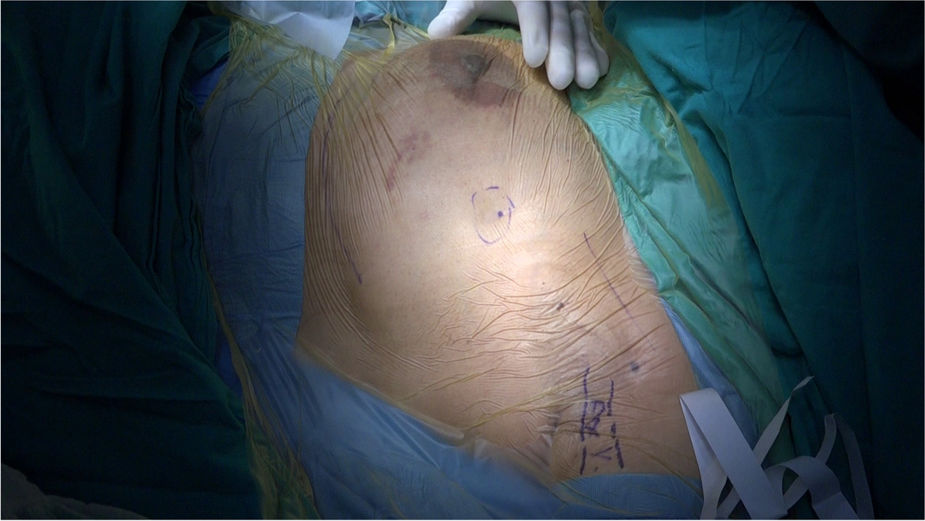 Ultrasound-Guided Methylene Blue Delineated and Ioban-Immobilized Excision of Discrete Breast Cancer: A Novel Technique for Breast Conserving Surgery
