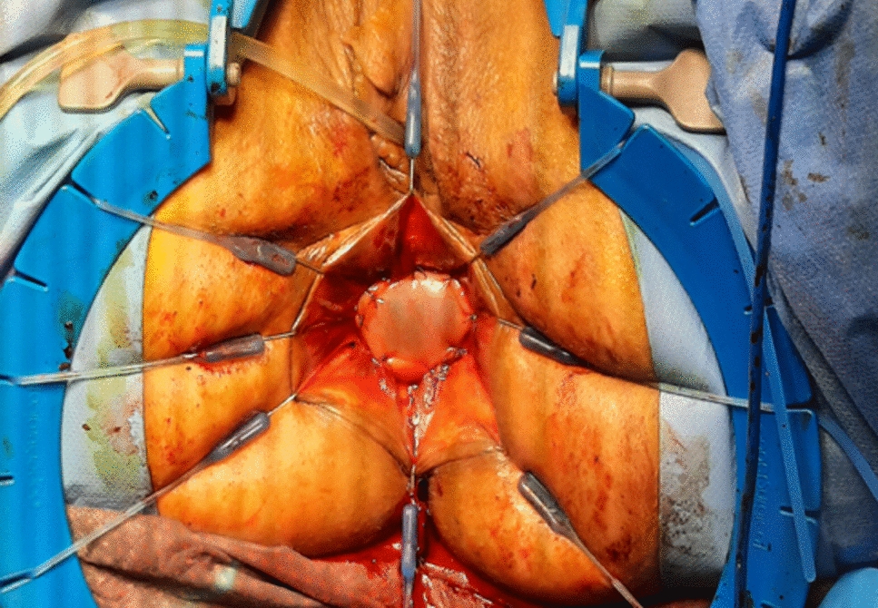 Ghost anastomosis: a new option for coloanal anastomosis