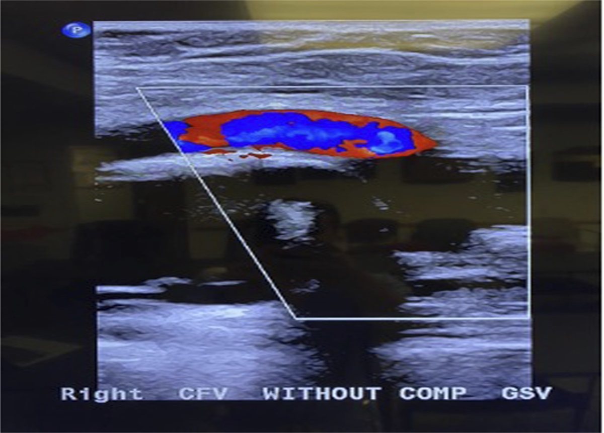 Paralabral Cyst of the Hip Causing Deep Vein Thrombosis Treated with Arthroscopic Decompression and Labral Repair
