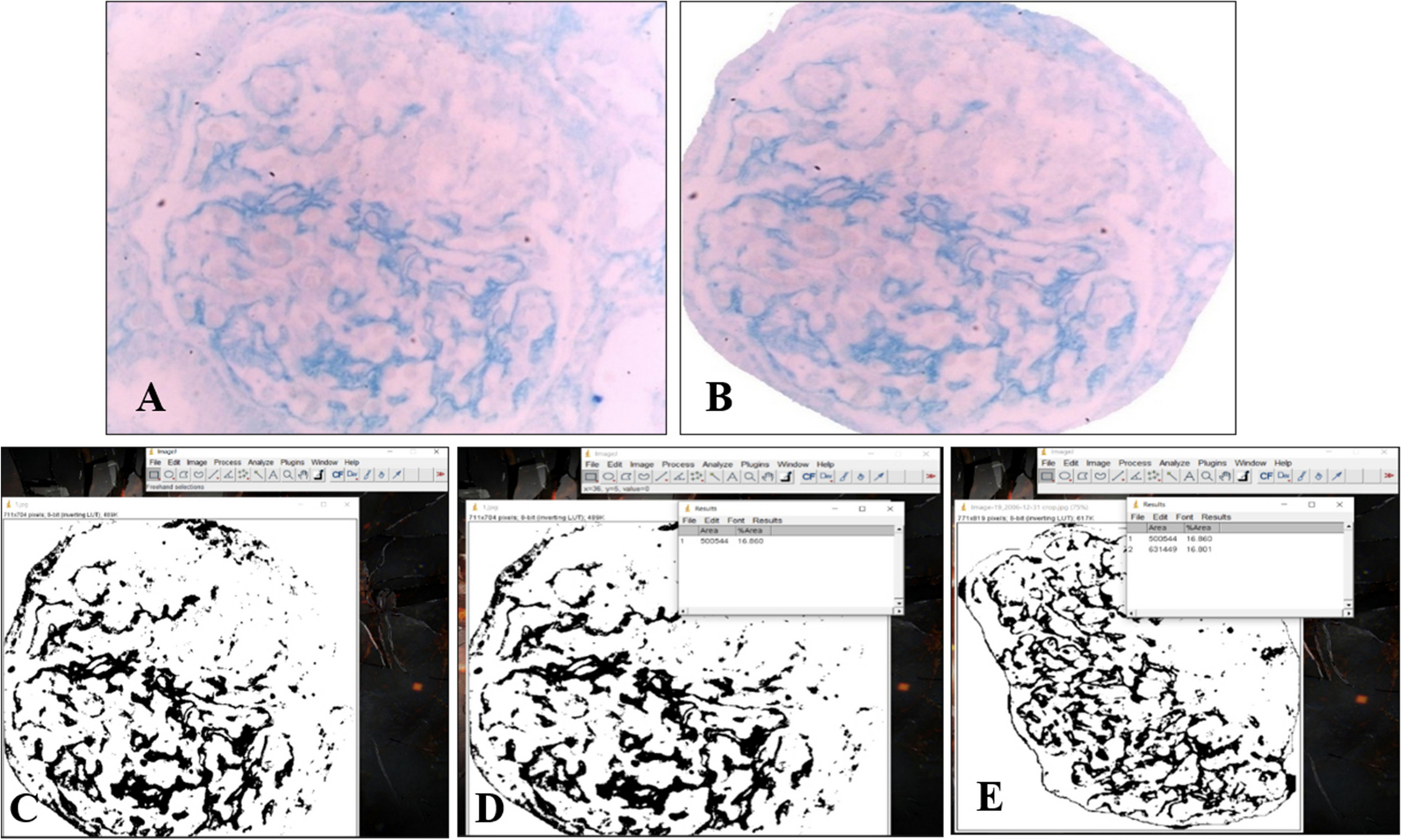 Assessment of podocyte detachment as a pivotal step in the development of focal segmental glomerulosclerosis
