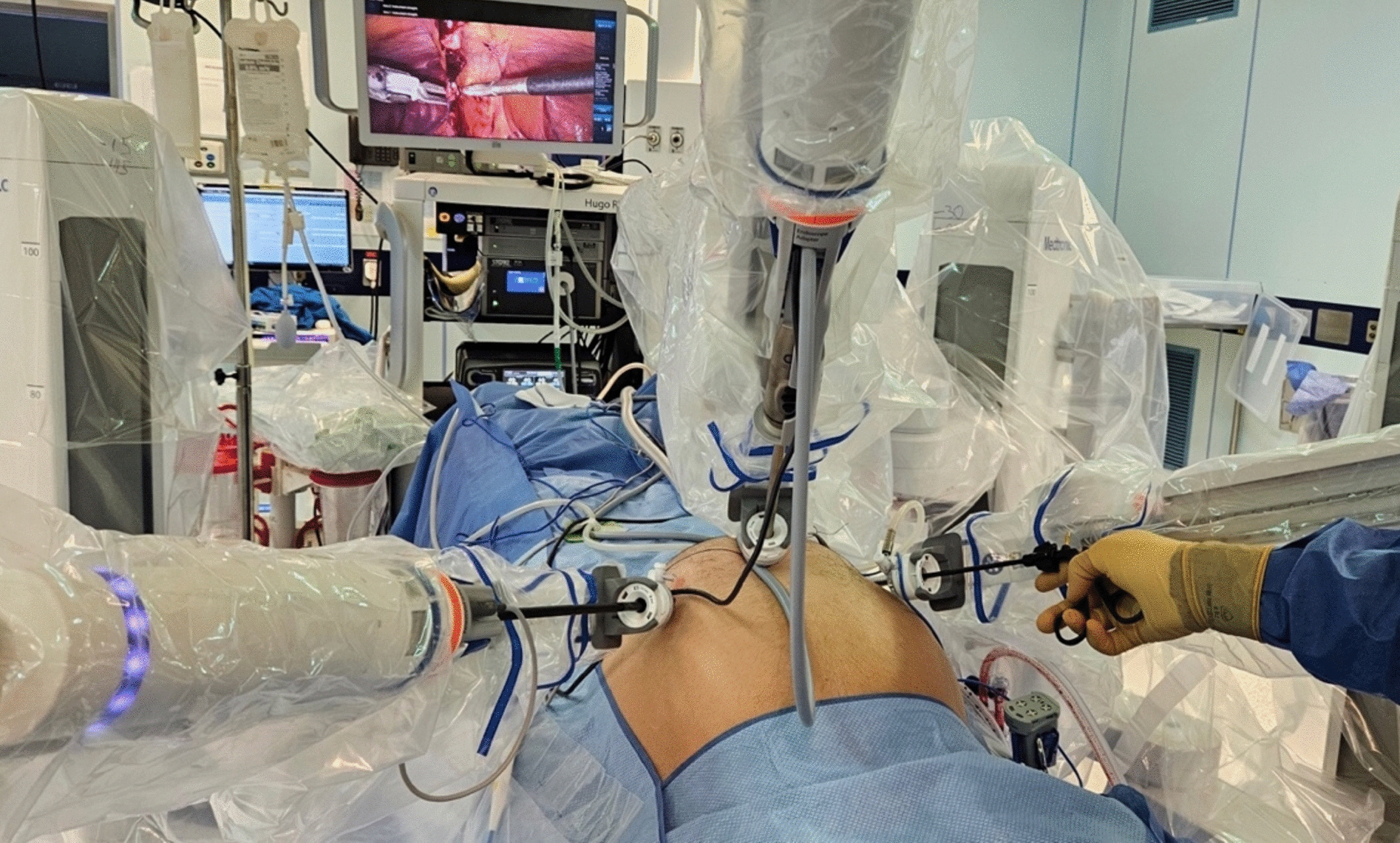 A simple technique to improve docking time in robotic surgery