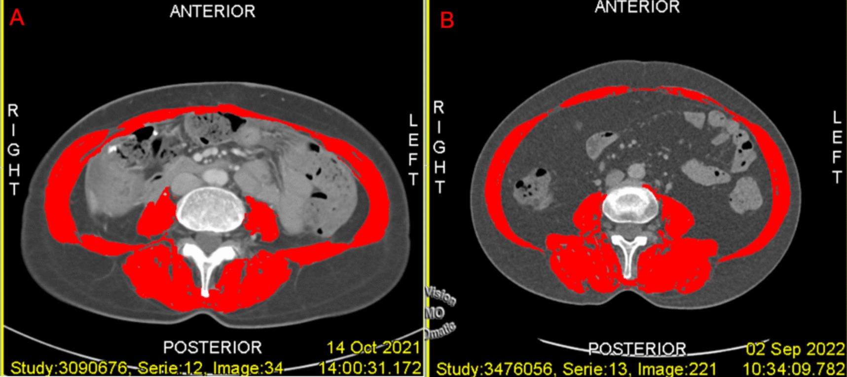 The impact of sarcopenia on postoperative complications and survival outcomes after robotic colorectal cancer surgery: a study based on single-center propensity score matching