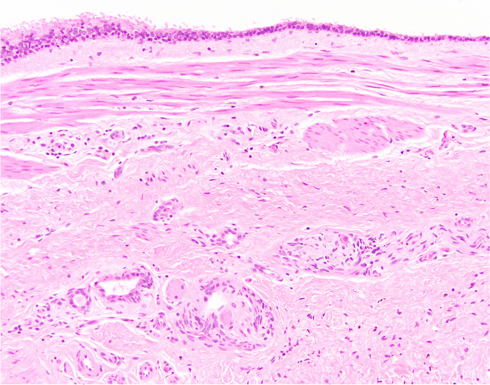 Cystic masses of the pediatric lung: update on congenital pulmonary airway malformation and its differential diagnosis