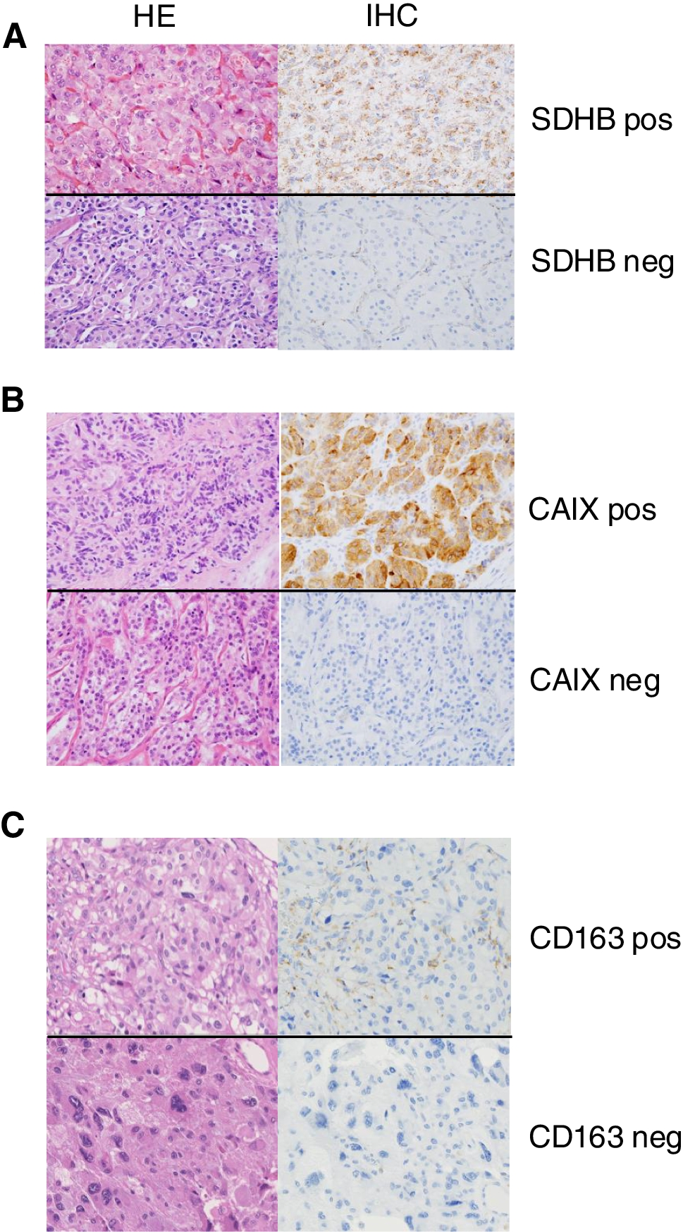 Prognosis and tumor microenvironment in pseudohypoxic pheochromocytoma/paraganglioma
