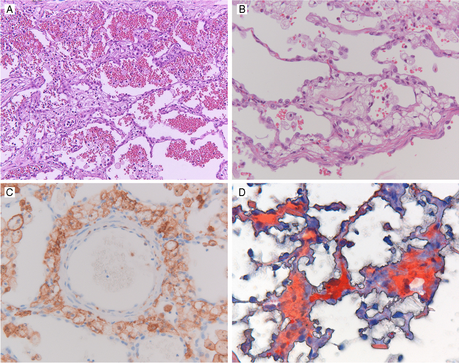 Interstitial lipoid pneumonia—A complication of intravenous administration of lipid emulsions in critically ill patients