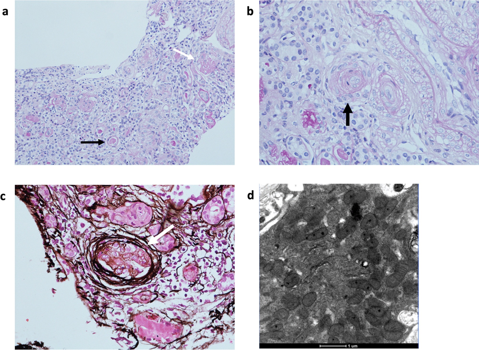 Familial thrombotic microangiopathy in a child with coenzyme Q10 deficiency-associated glomerulopathy