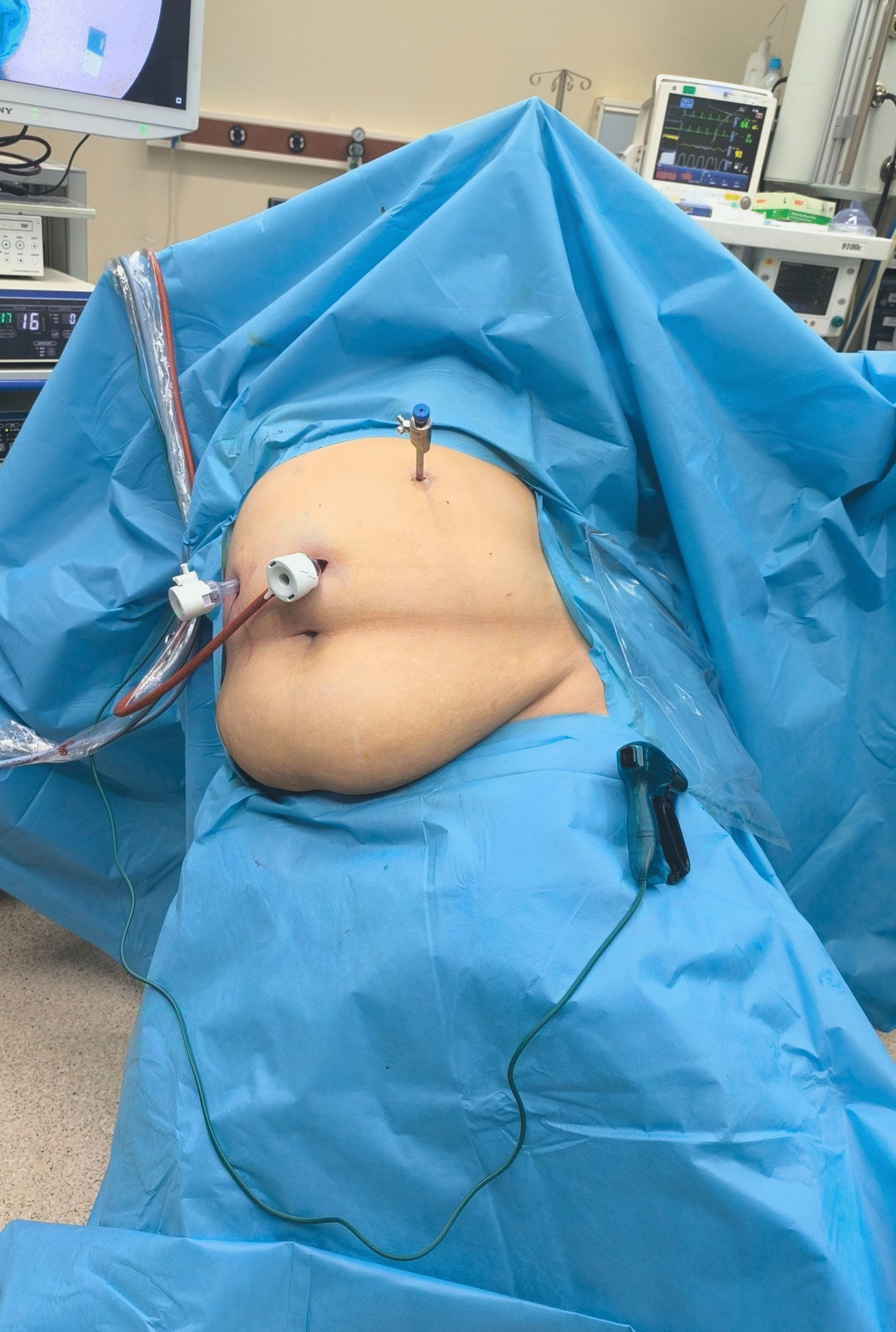 A Comparative Analysis of the Liver Retraction with Long Surgical Gauze in Three-Port Sleeve Gastrectomy and the Four-Port Nathanson Retractor Technique