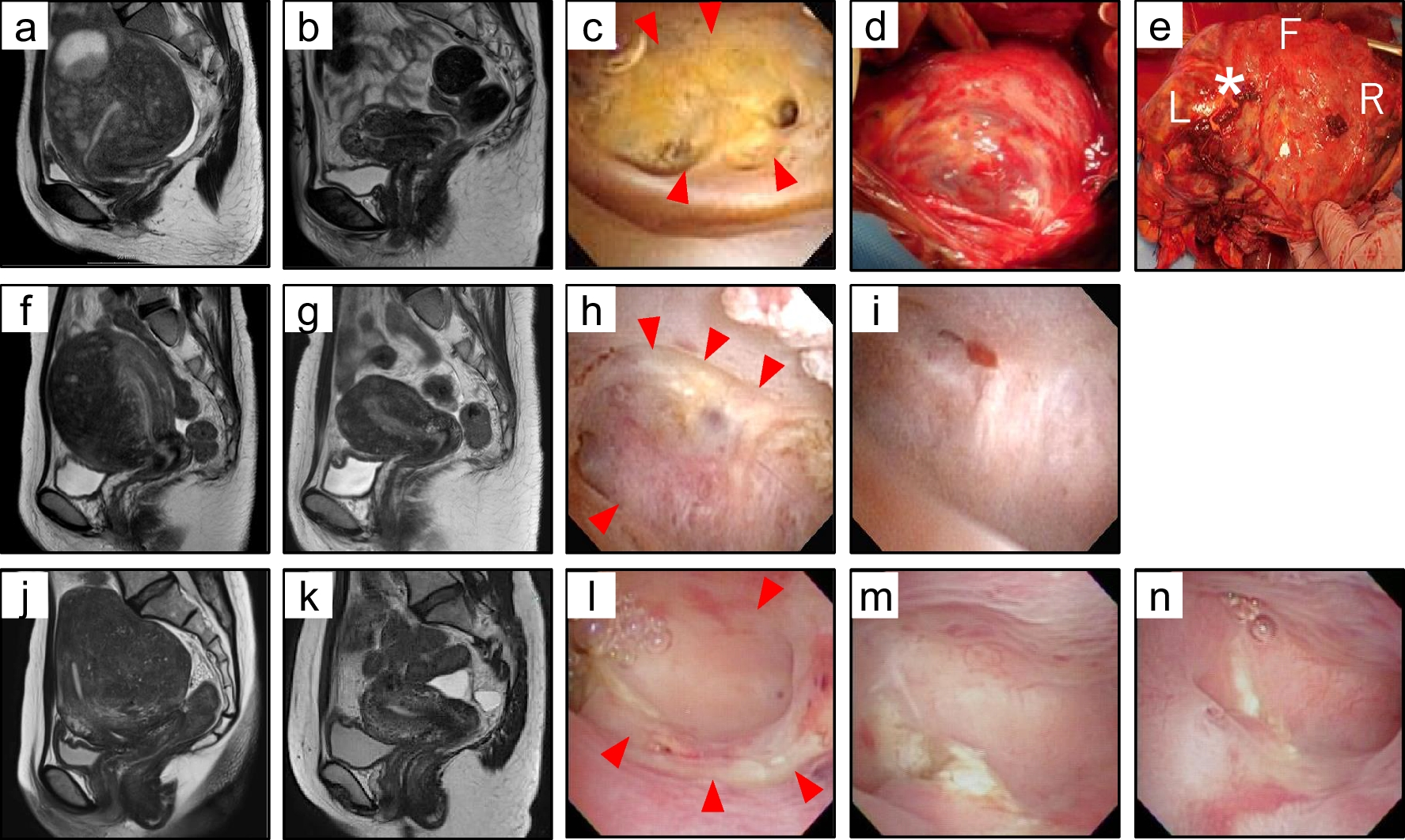 Hysteroscopic Endometrial Defect Following Adenomyomectomy and Incidence of Placenta Accreta Spectrum and Uterine Rupture Complications for Subsequent Pregnancy