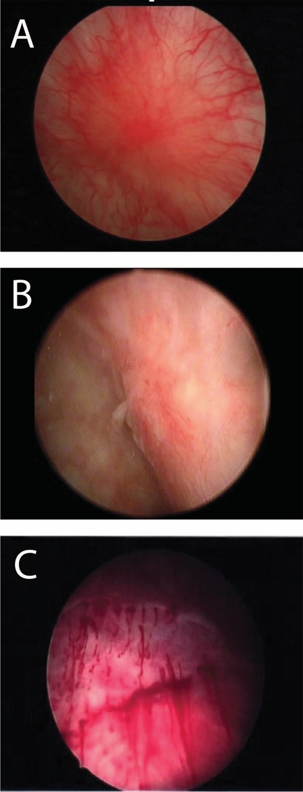 Joint Terminology Report: Terminology Standardization for Female Bladder Pain Syndrome