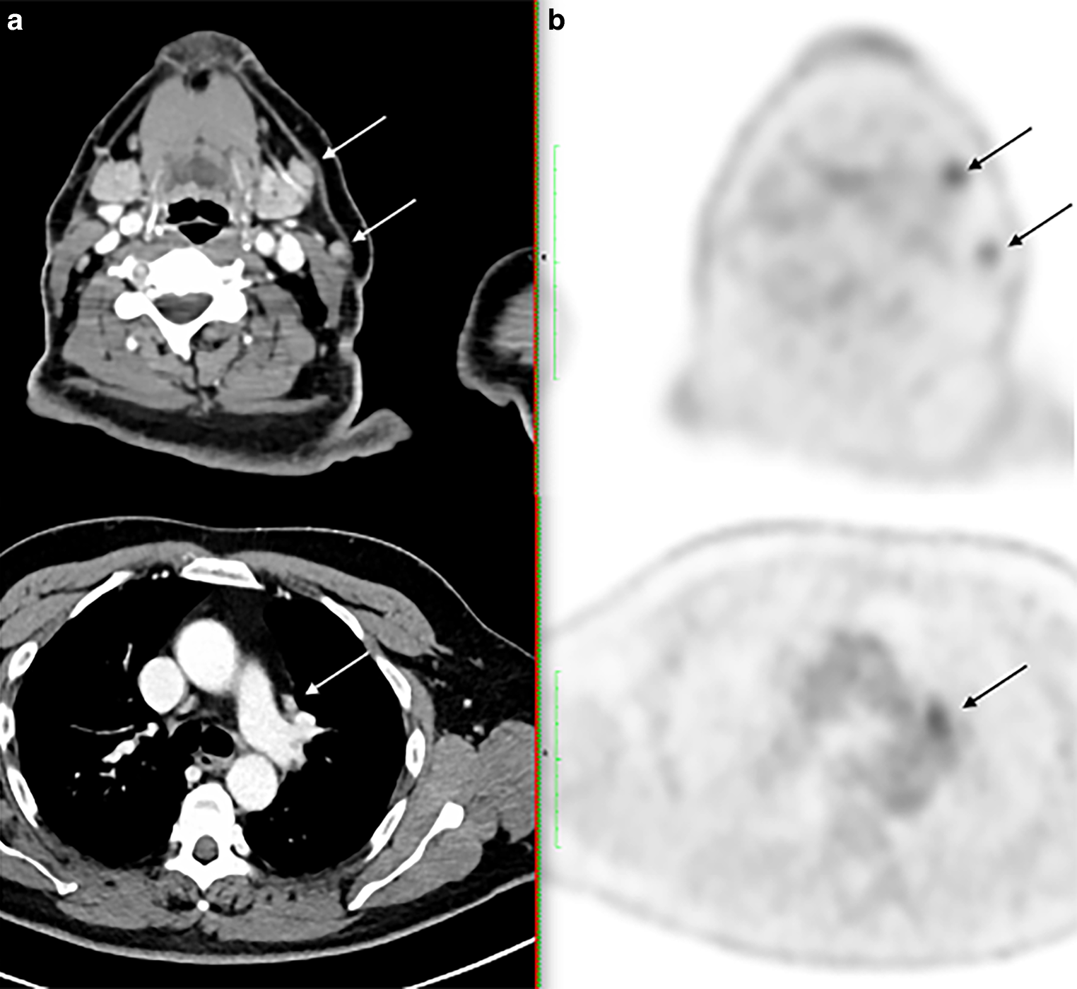 PET/CT-based target volume definition in involved-site radiotherapy for treatment of early-stage nodal follicular lymphoma