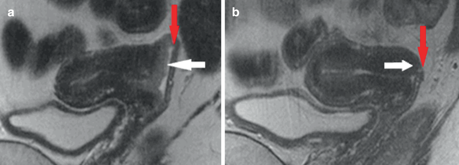 Neoadjuvant radiochemotherapy in patients with high-risk locally advanced cervical cancer—results of a clinical series
