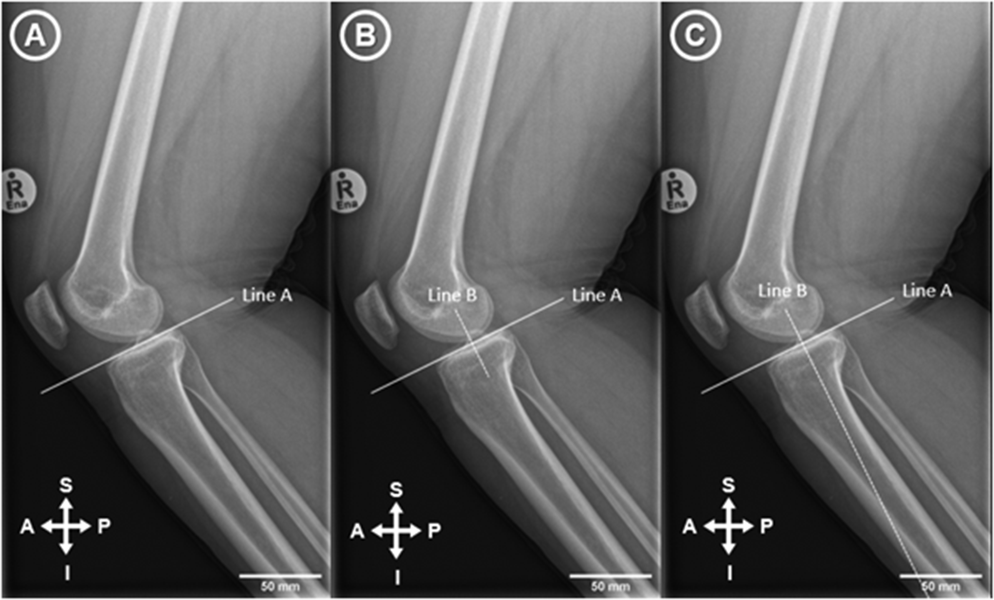 A morphometric study of posterior tibial slope differences by sex and ethnicity in a South African population