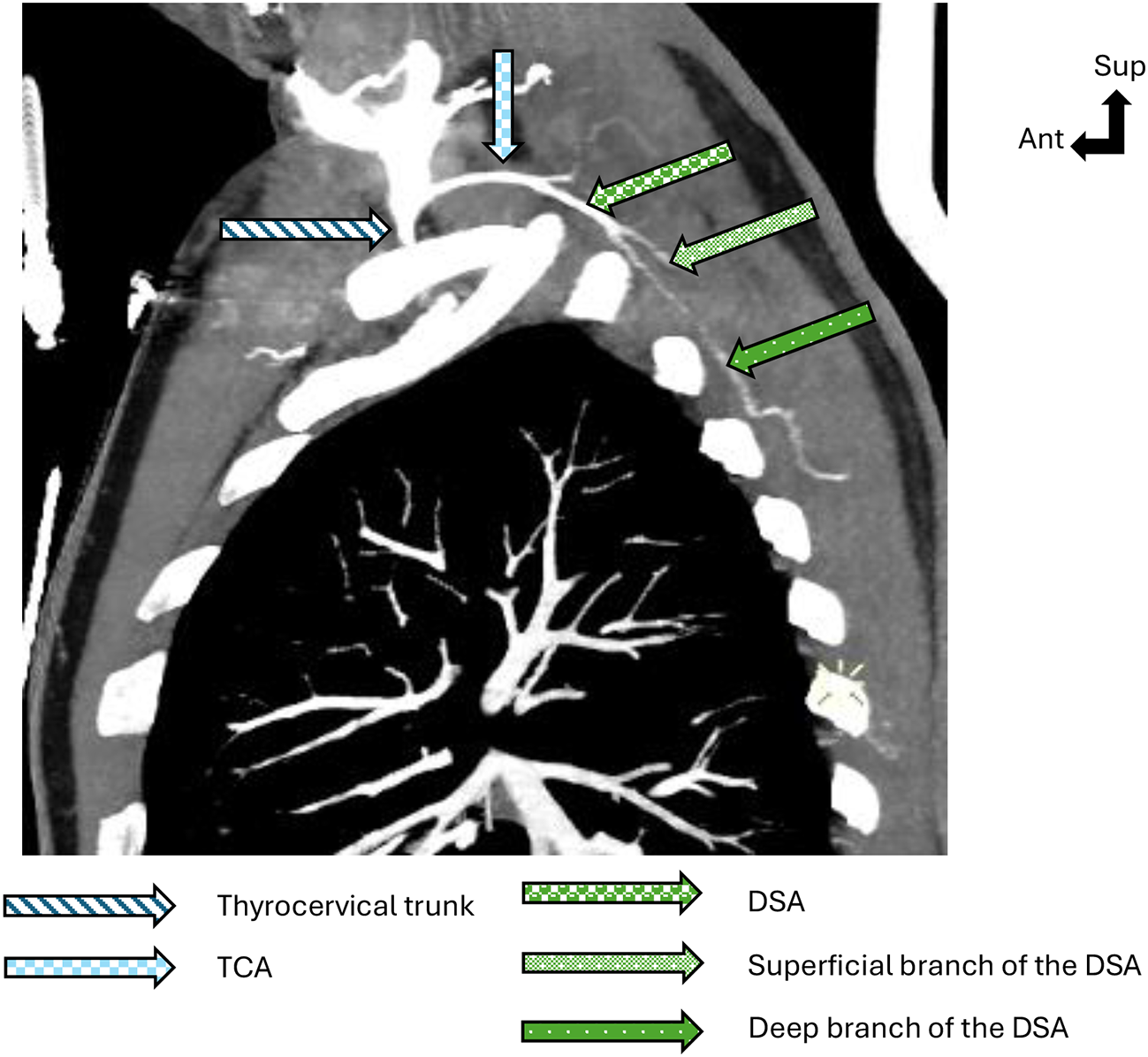 Anatomical study of the vascularization of the pedicled osteo-myo-cutaneous scapulo-dorsal flap