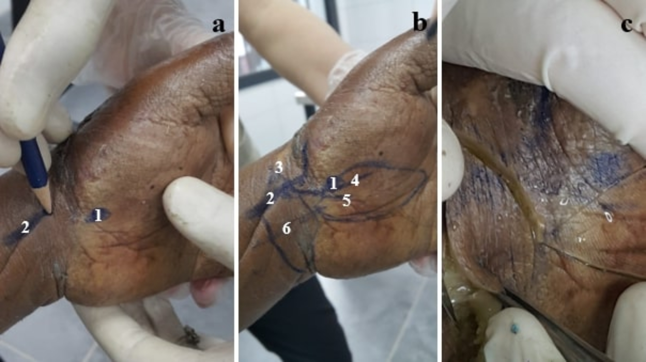 Superficial palmar branch of radial artery flap for digital skin reconstruction: anatomical study and clinical applications