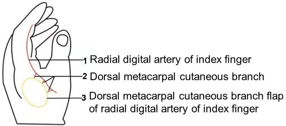 Anatomical basis and clinical application of the dorsal metacarpal cutaneous branch flap of radial digital artery of index finger