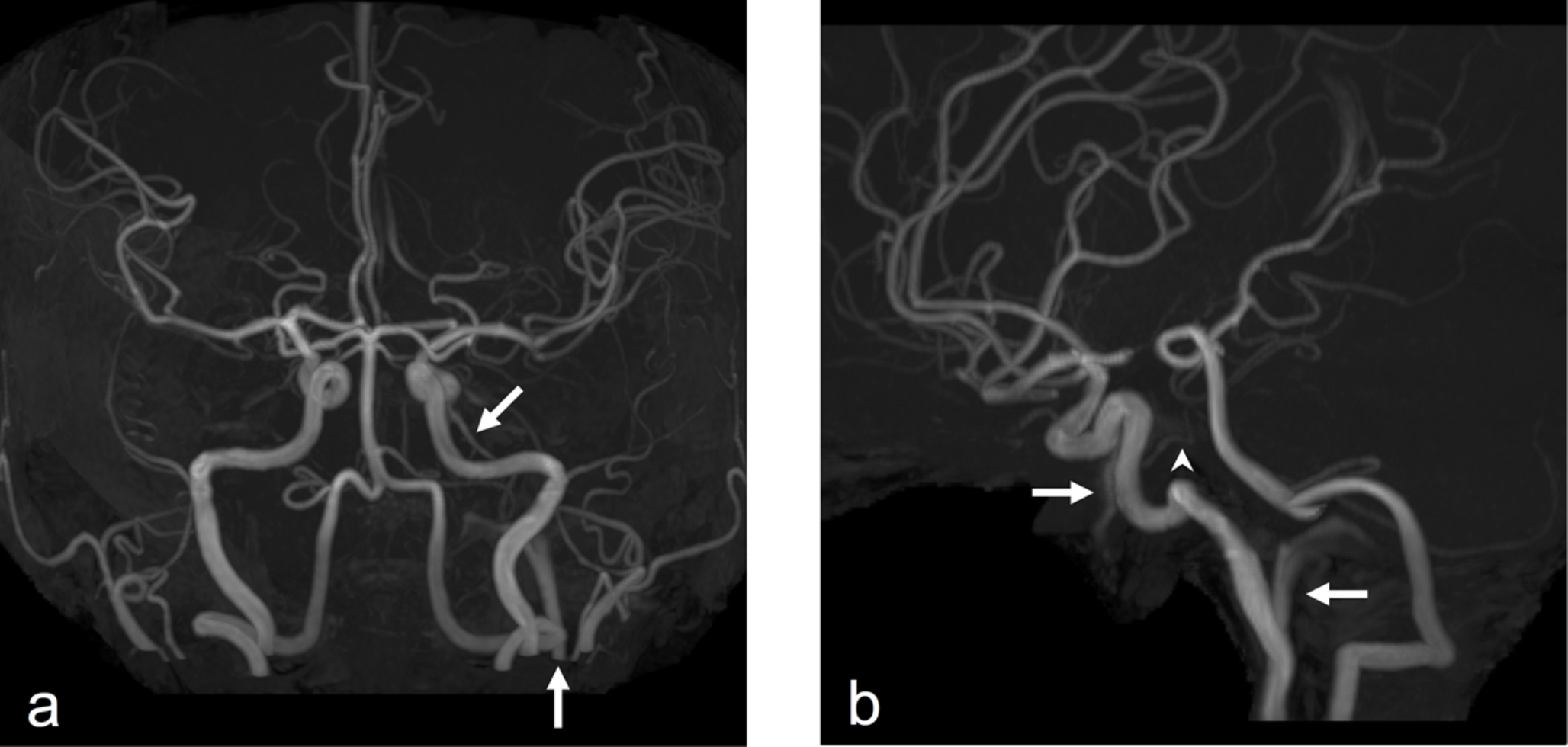 Persistent trigeminal artery variant as a duplicate anterior inferior cerebellar artery