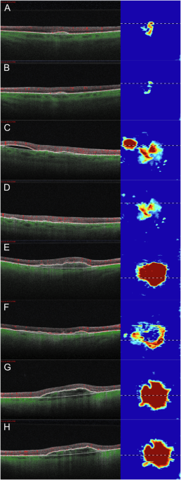 Analysis of quantitative OCT and SS-OCTA metrics three months after initiation of intravitreal faricimab for treatment-recalcitrant neovascular AMD