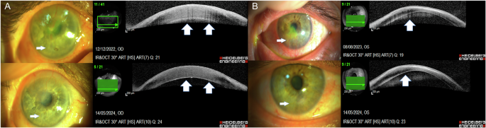 Assessment of corneal vessels activity through the ‘Barcode sign’ of corneal OCT