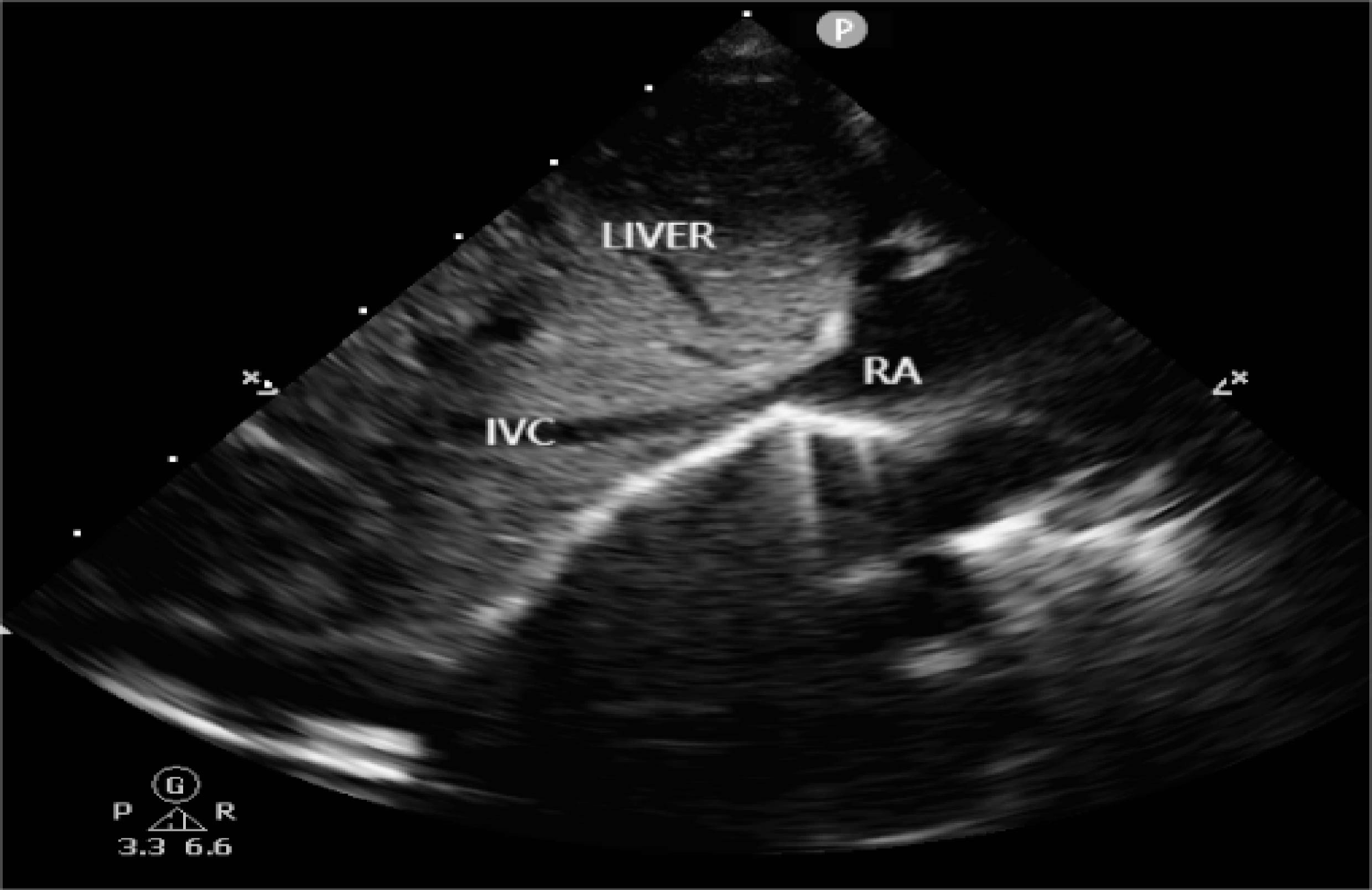 Abnormal characteristics of inferior vena cava and abdominal aorta among neonates with early onset septic shock