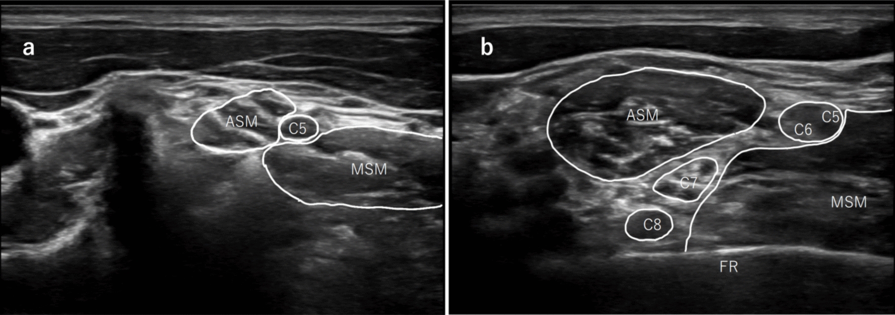 Ultrasound assessment of the frequency and variation of arteries in the interscalene region