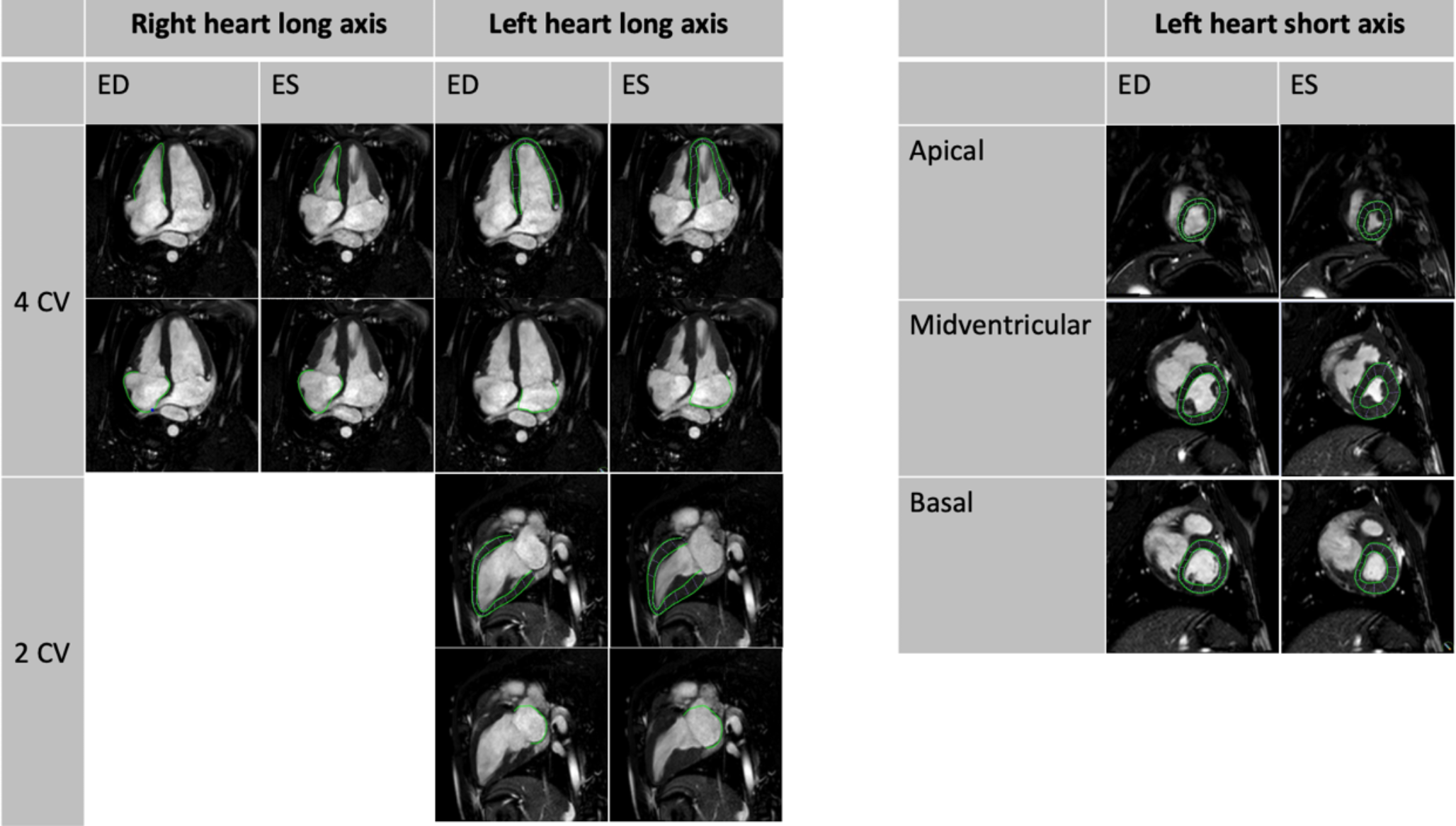 Evaluating pulmonary stenosis and regurgitation impact on cardiac strain and strain rate in a porcine model via magnetic resonance feature tracking