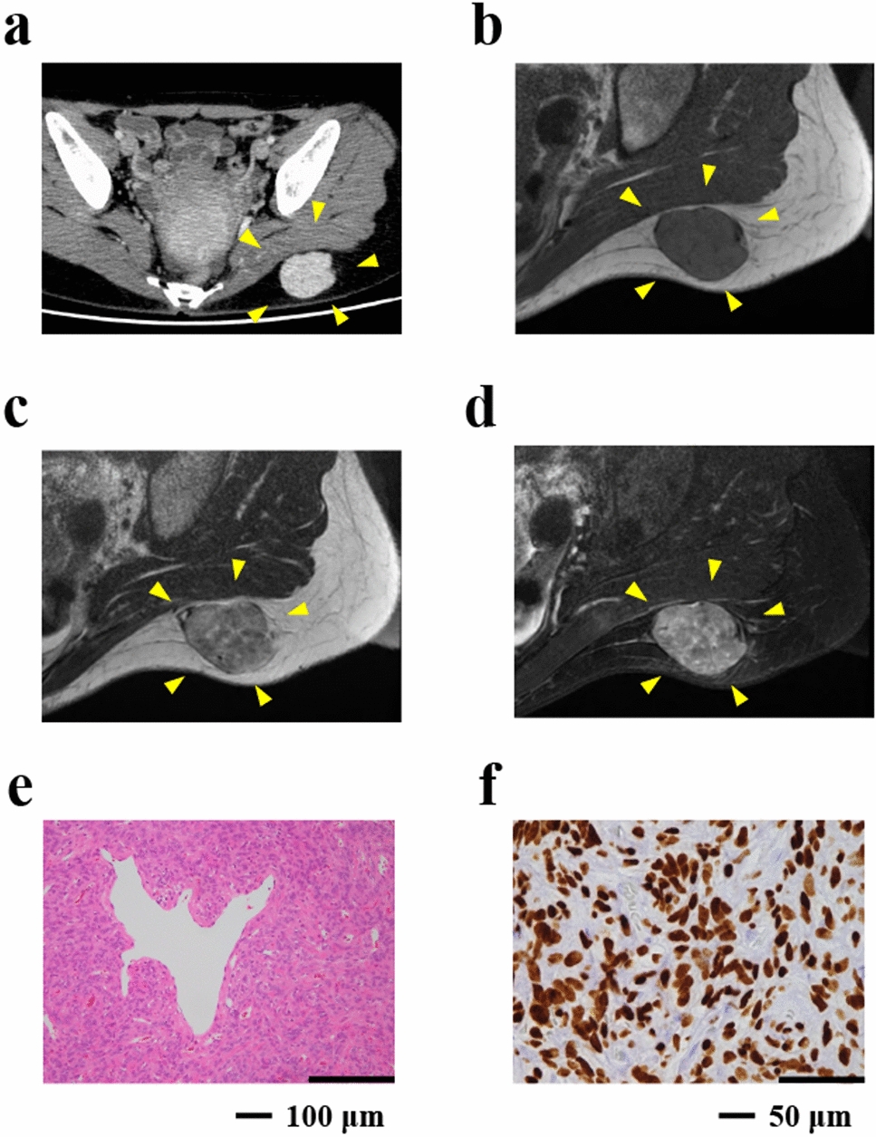 Establishment and characterization of NCC-SFT1-C1: a novel patient-derived cell line of solitary fibrous tumor