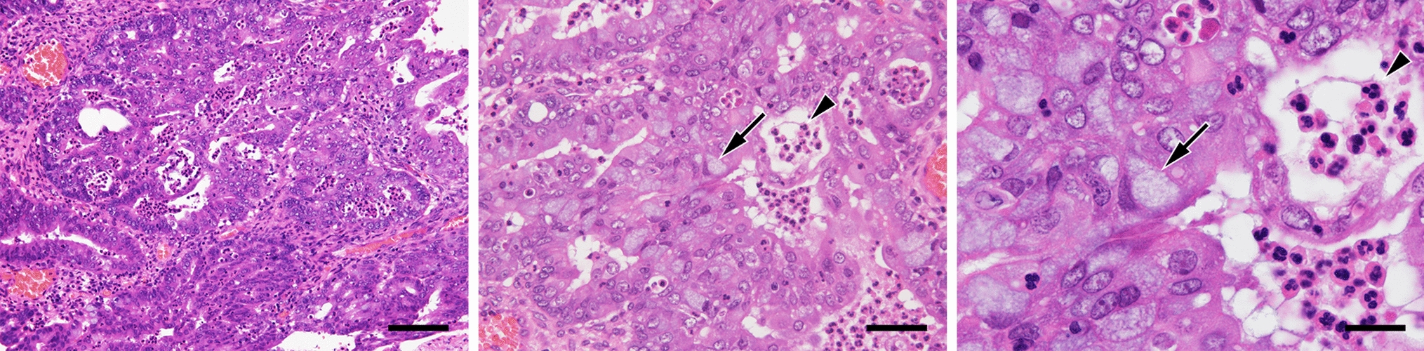 Establishment of a human ovarian endometrioid carcinoma cell line by constitutive expression of cyclin-dependent kinase 4, cyclin D1 and telomerase reverse transcriptase