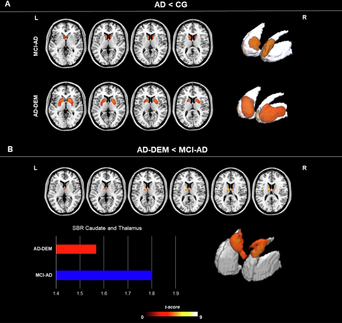 Dopaminergic deficits along the spectrum of Alzheimer’s disease