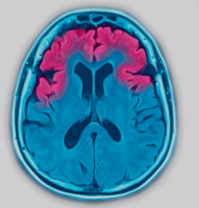 Gains in early-onset dementia with progranulin open new paths for drug discovery