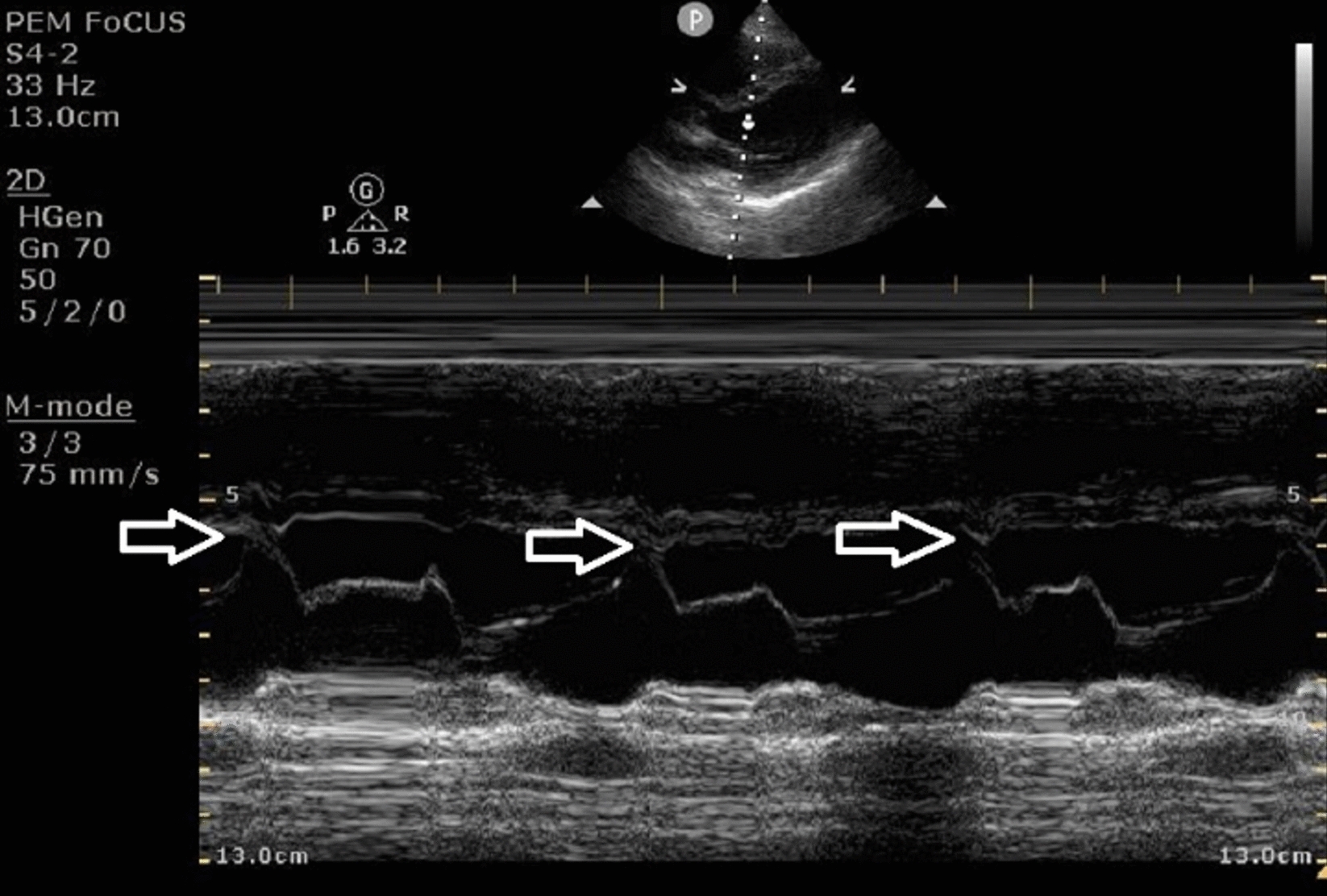 Quantitative valve motion assessment in adolescents using point-of-care ultrasound: short communication