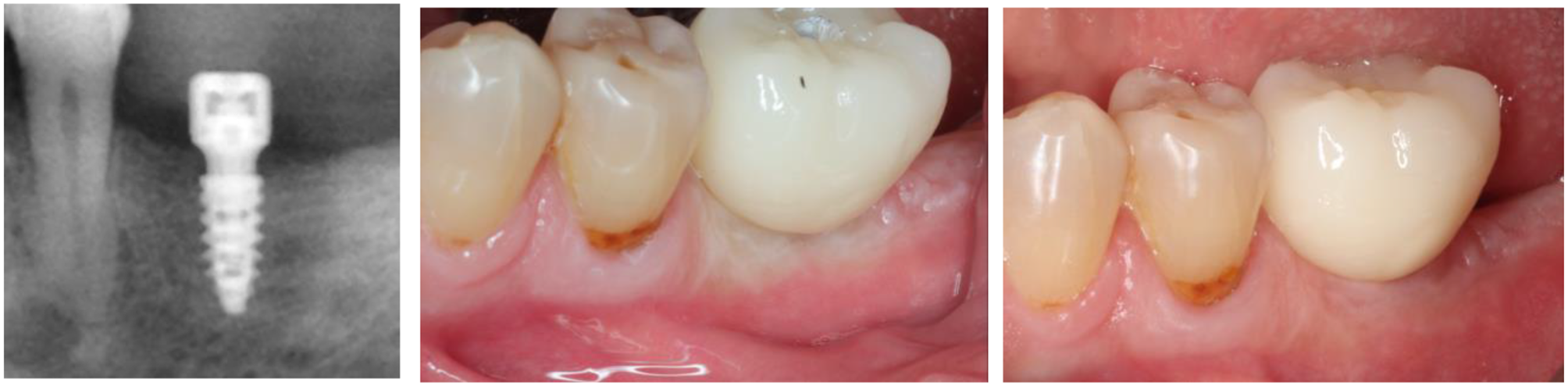 A digital way to assess the stain parameters that lead to soft tissue blanching when delivering an implant-supported crown