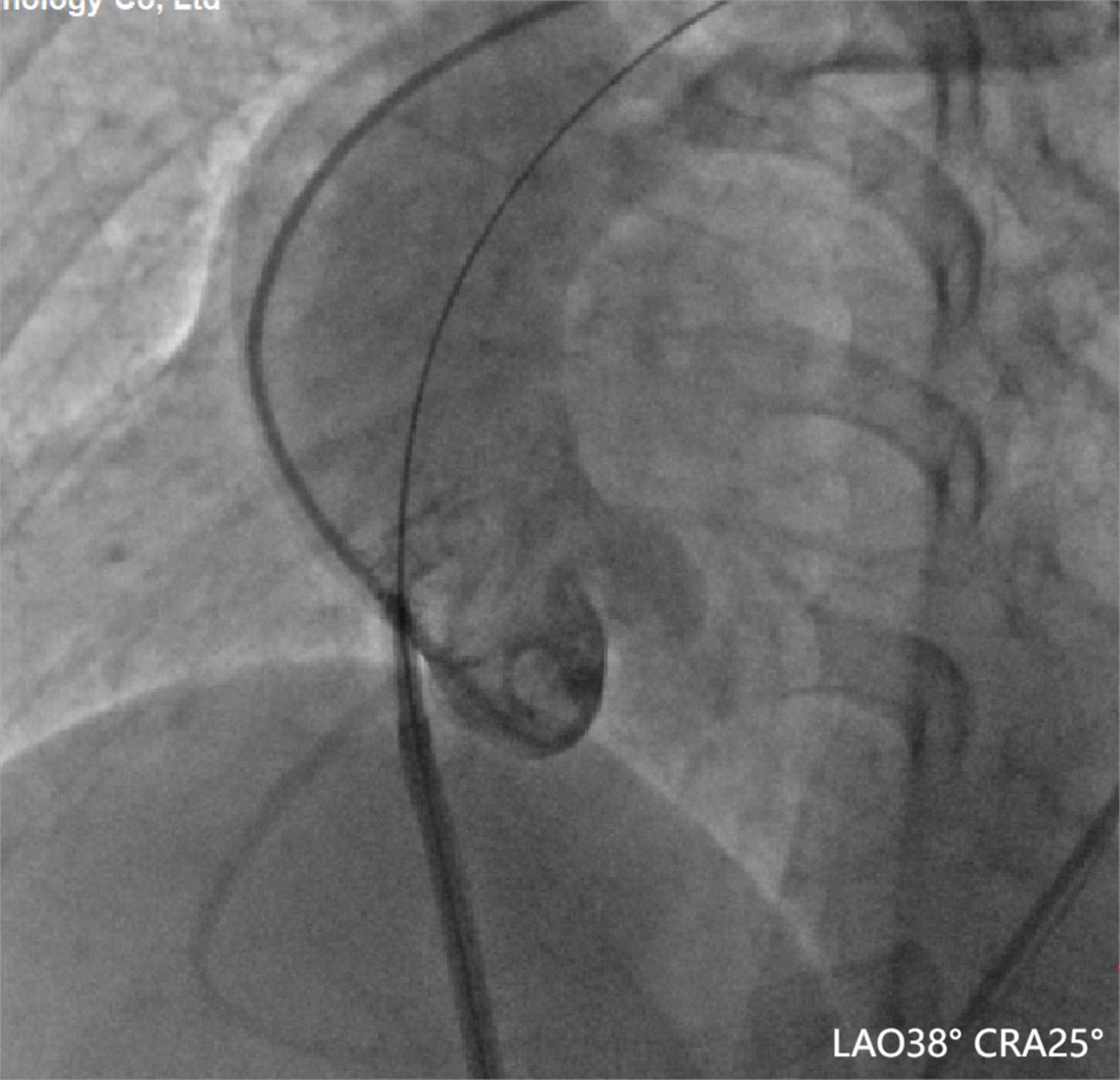 Closure of an ascending aorta perforation during a transseptal puncture procedure: transcatheter closure with a muscular ventricular septal defect occluder