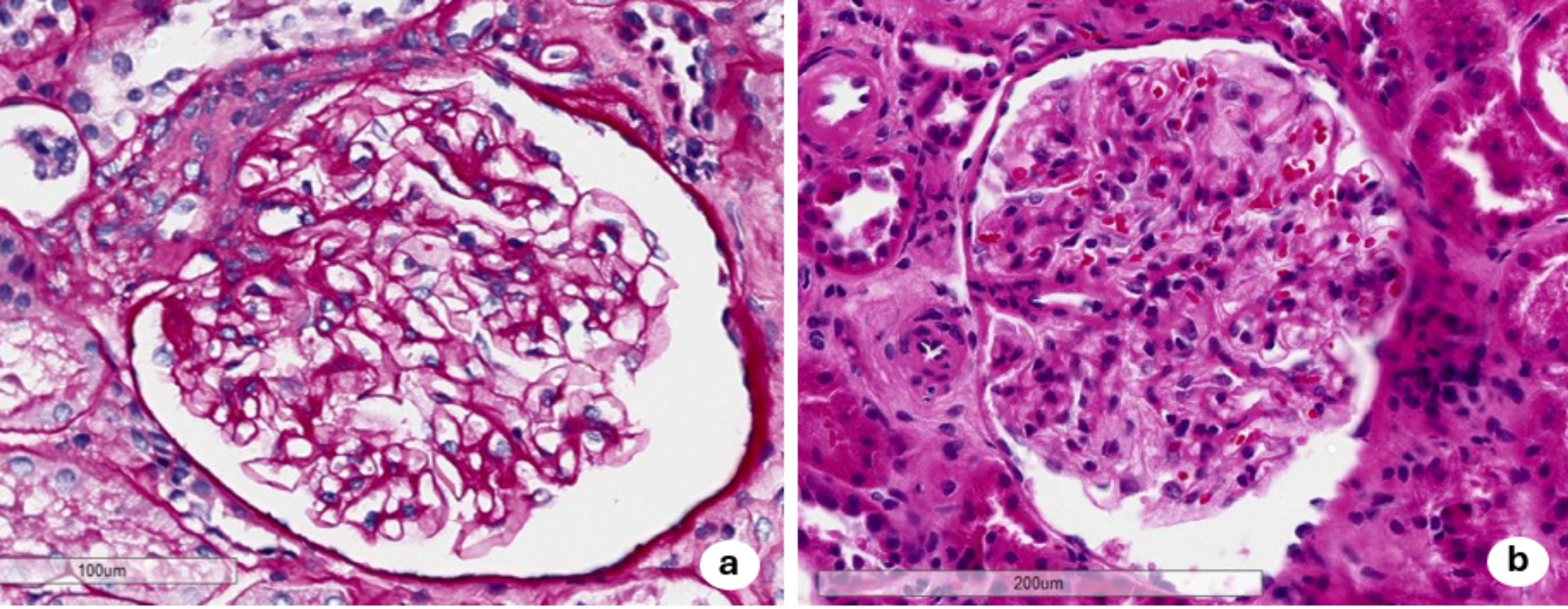 The importance of a multidisciplinary approach in two tricky cases: the perfect match for Fabry disease