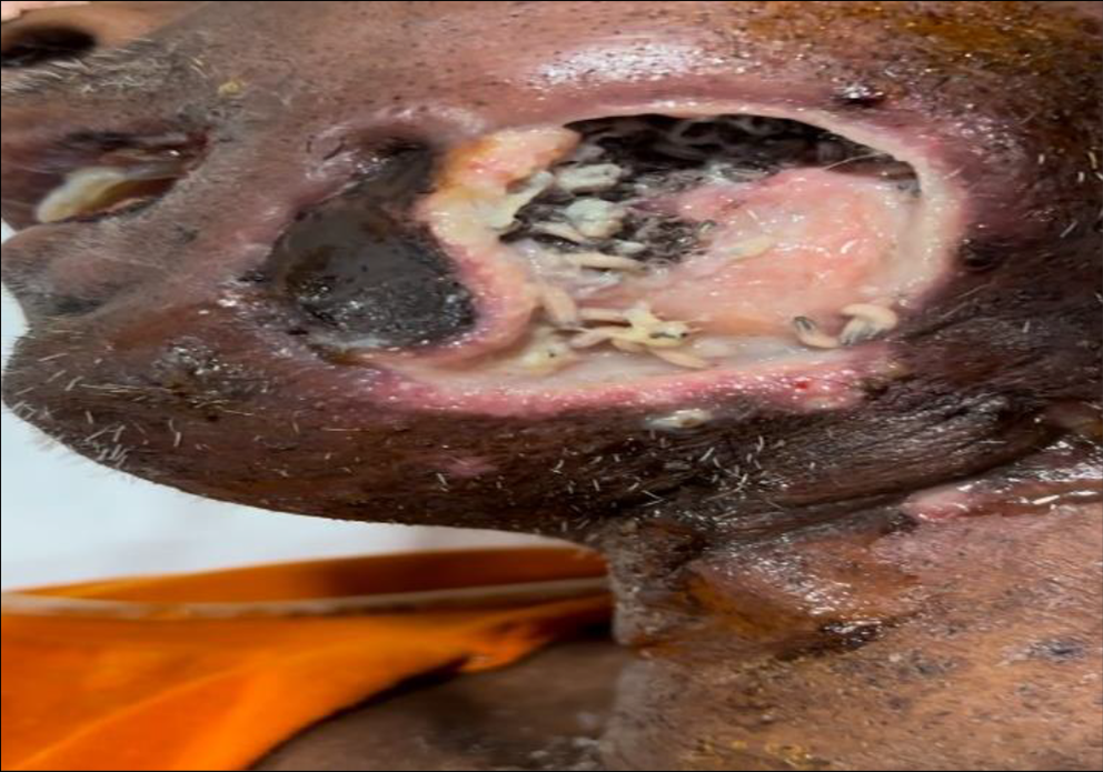 Management of Malignant Wound Myiasis in Advanced Head‑and‑Neck Cancer Patients: A Prospective Observational Study