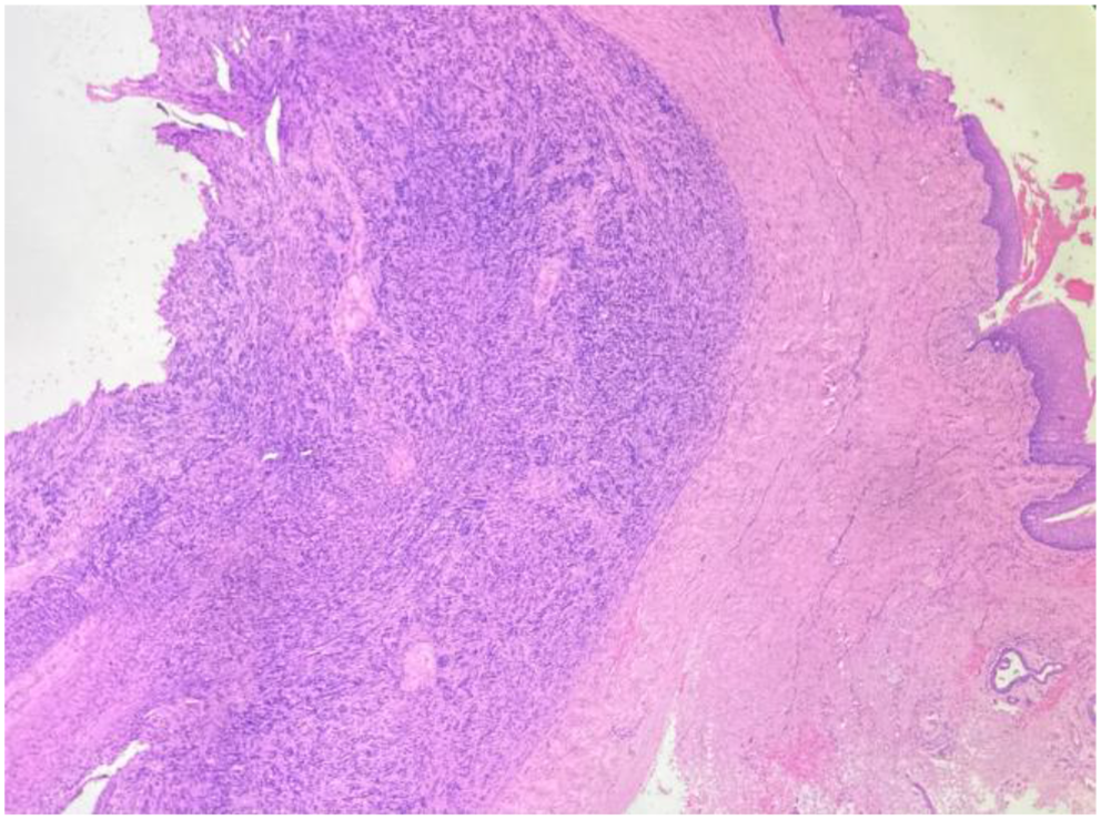 Endoscopic Approach to Laryngeal Schwannoma: A Case Report