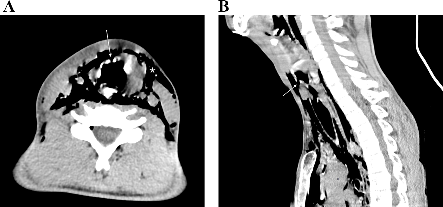 Cricotracheal Separation with Esophageal Laceration in Blunt Neck Trauma: A Case Report