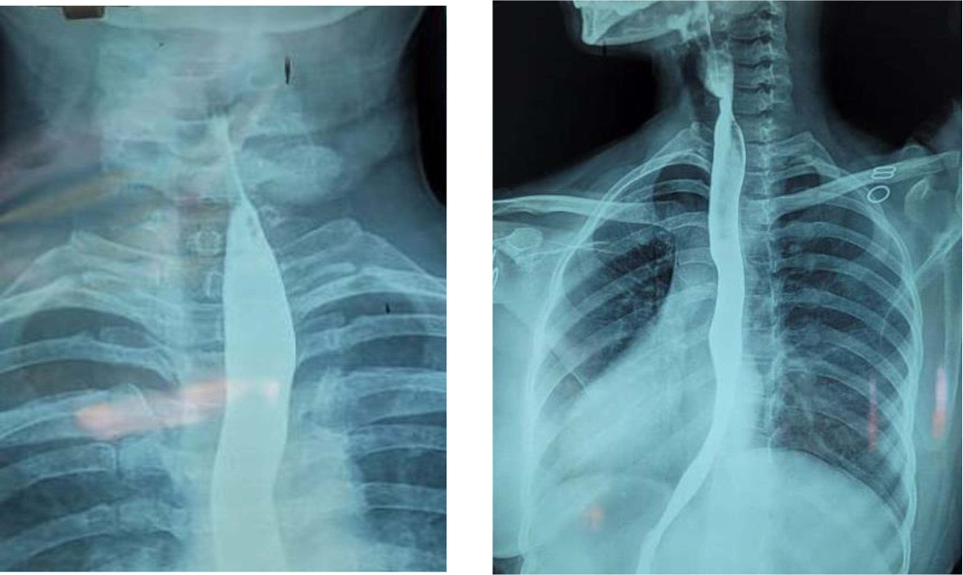 A Study on Association Between Anaemia and Cricoid Webs in Patients with Dysphagia Attending a Tertiary Care Hospital in Chengalpattu District