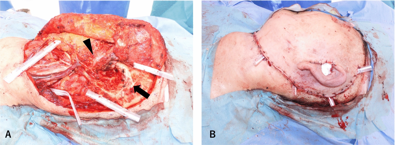 A Study of Cases in Which Penrose Drains Were Selected for Postoperative Hemorrhaging After Head and Neck Surgery