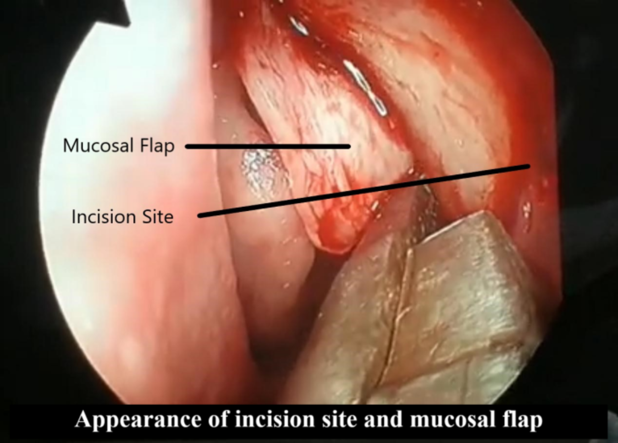 Comparison of the Results of Endoscopic Dacryocystorhinostomy with and without the Preservation of Nasal Mucosal Flap