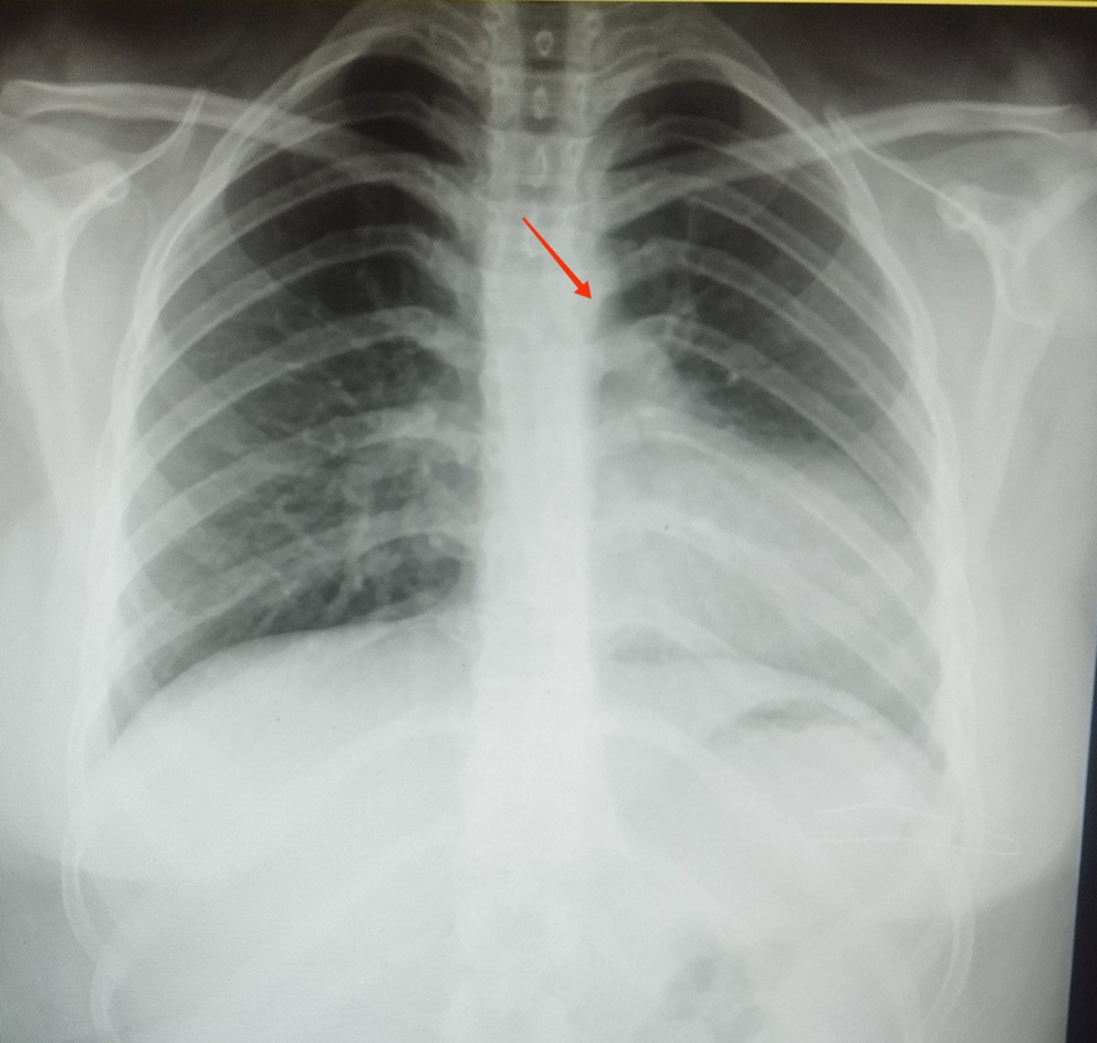 Congenital unilateral pericardial agenesis presenting as an isolated chest pain in an adolescent: a case report and comprehensive review