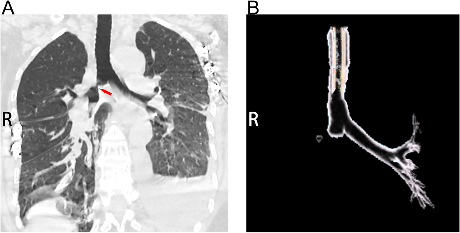 Surgical treatment of delayed partial bronchial rupture under venovenous extracorporeal membrane oxygenation support: a case report