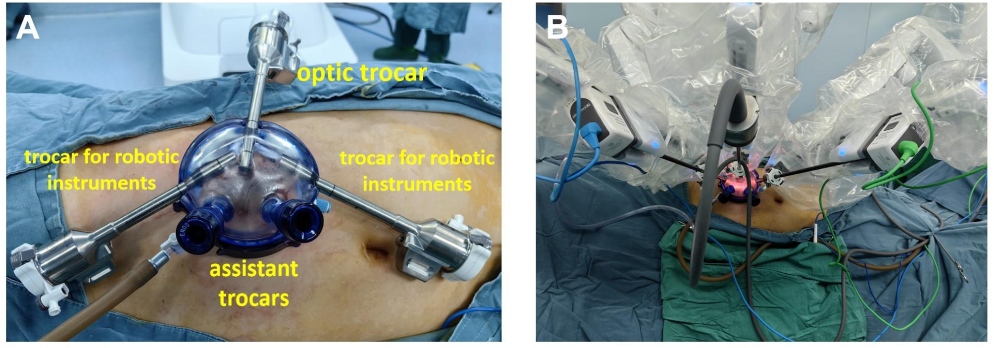 Robotic laparoendoscopic single-site ultrasound-guided renal artery balloon catheter occluded hybrid partial nephrectomy (LESS-HPN): a prospective pilot study