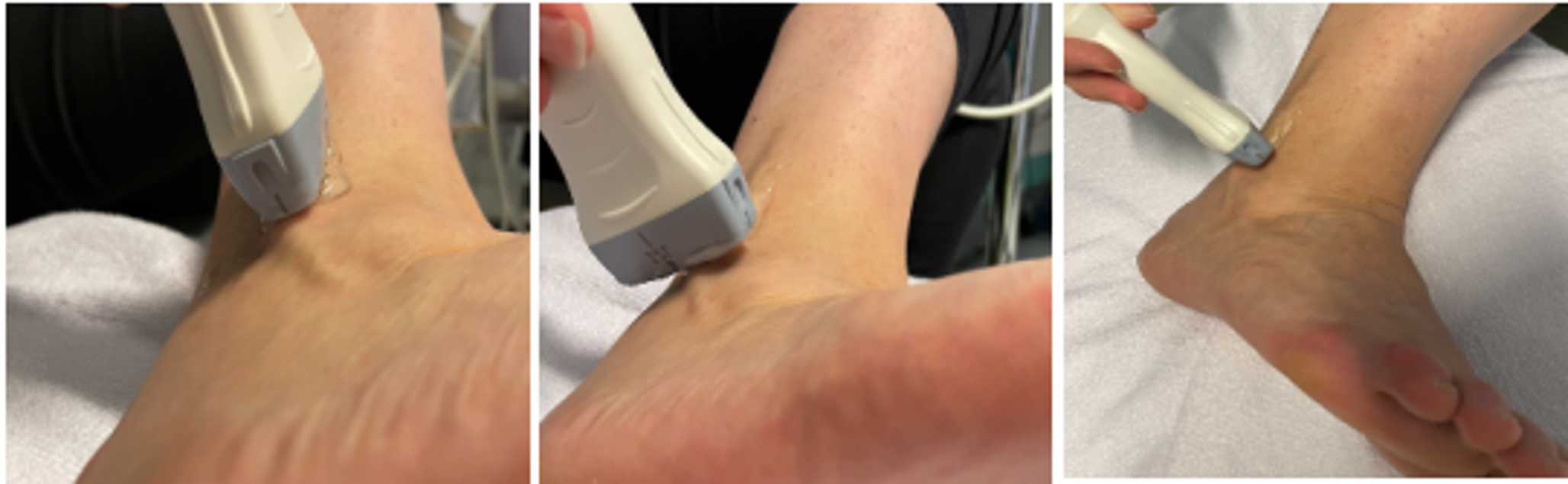 Diagnostic value of FAST ankle ultrasound compared to standard radiography for fracture detection in the emergency department by non-radiologist physicians: a monocentric prospective diagnostic cohort study
