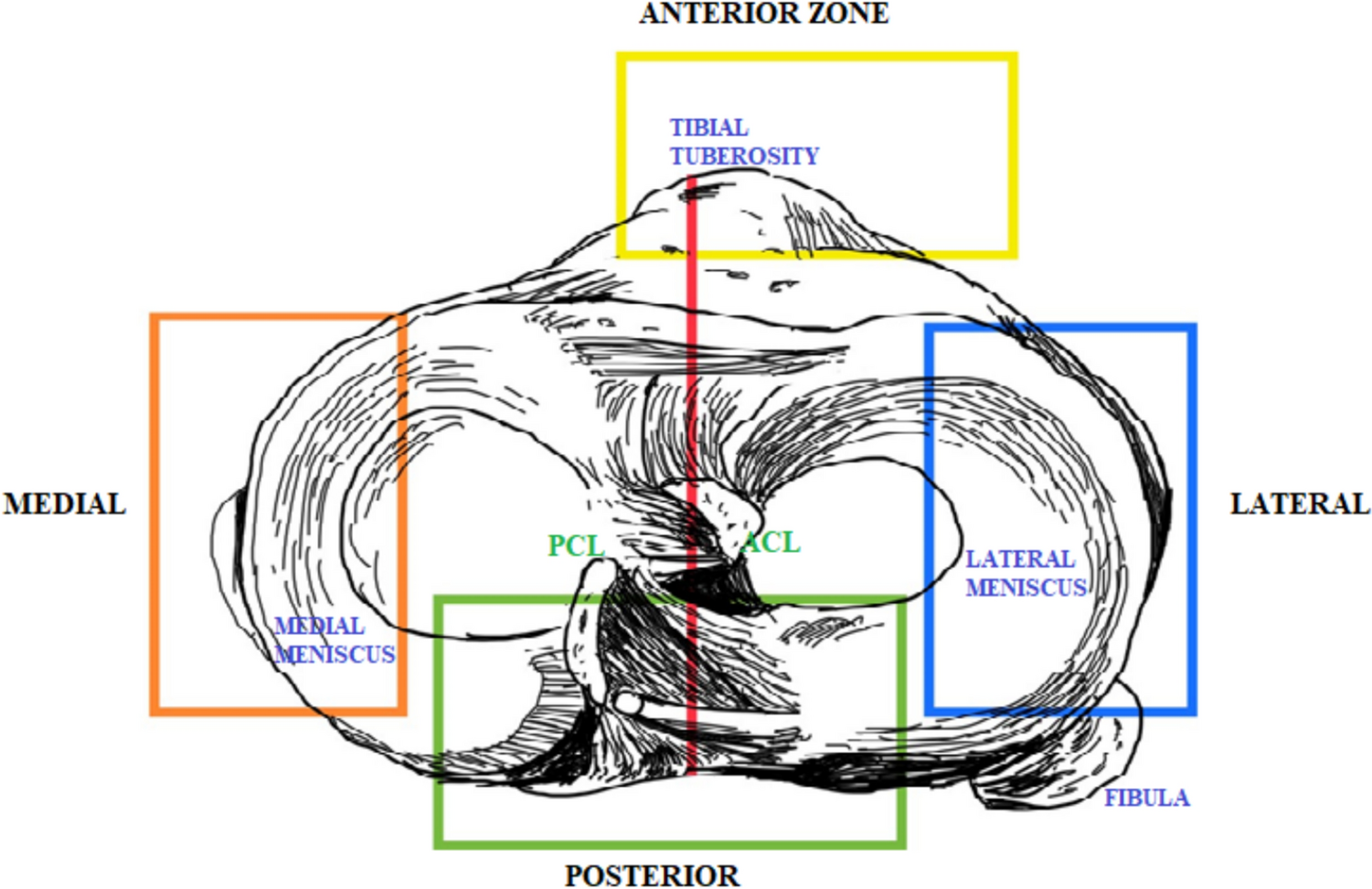 Modified Macroscopic Soft Tissue Injury (Modified MASTI) Classification for Bone and Soft Tissue Integrity in Cruciate Retaining Total Knee Arthroplasty