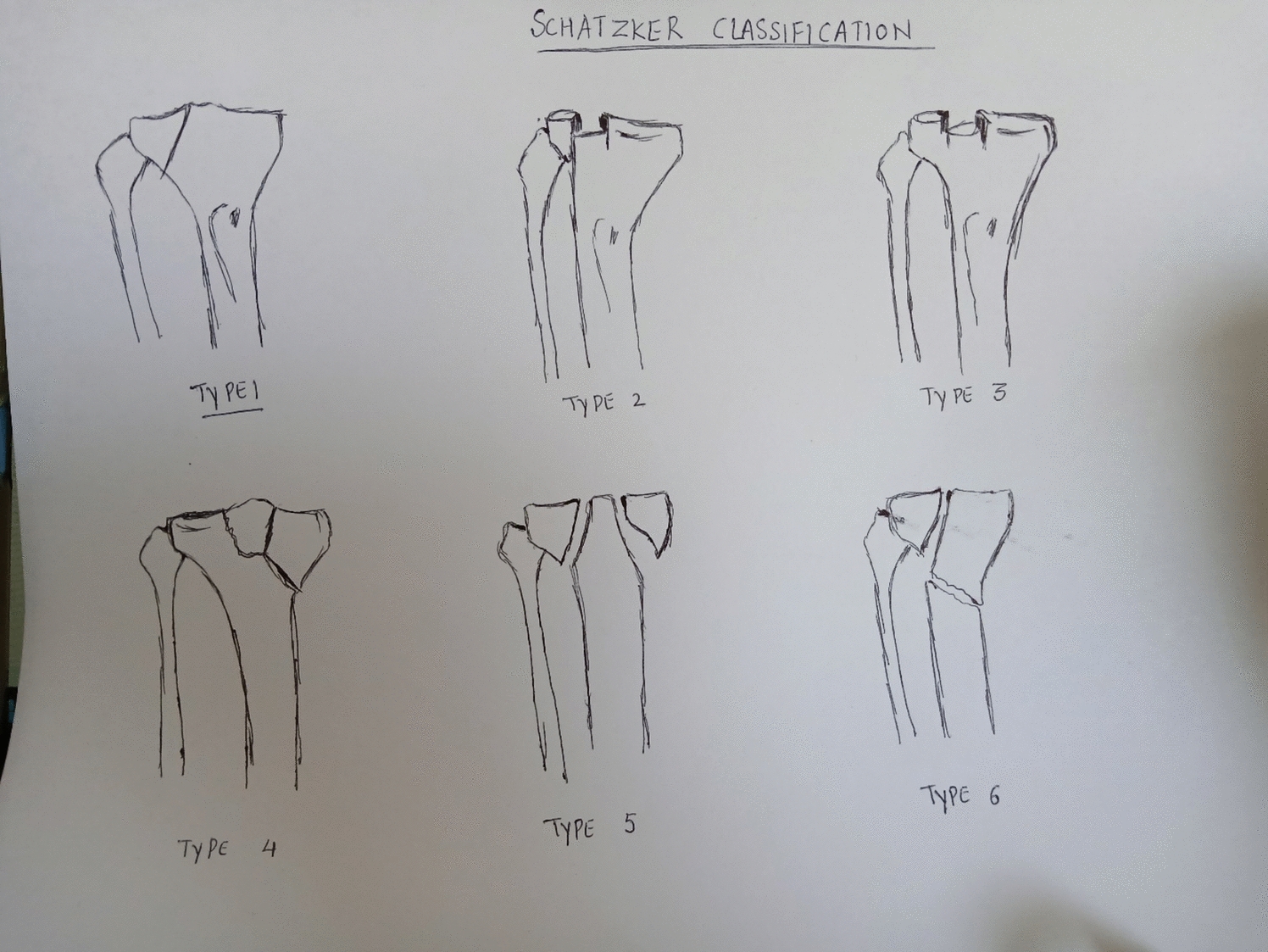 Proximal Tibia Fractures in Osteoporosis