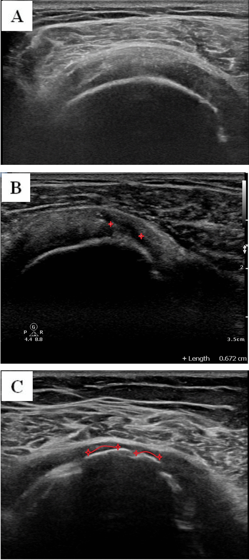 Asymptomatic Rotator Cuff Tears Among the Indian Population: Prevalence, Risk Factors, and Tear Characteristics