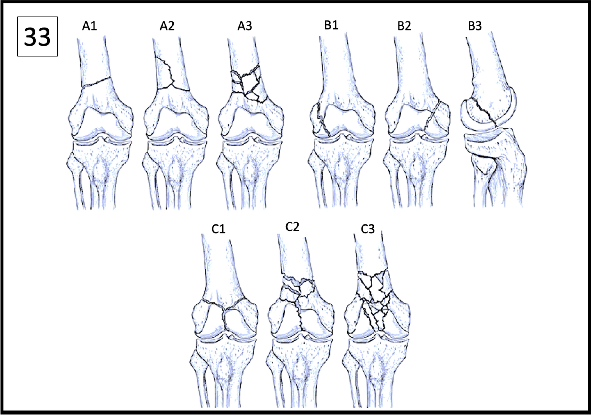 Osteoporotic Distal Femur Fractures: An Overview